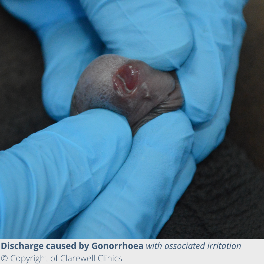 Gonorrhoea