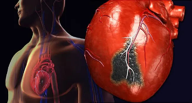 Heart Attack