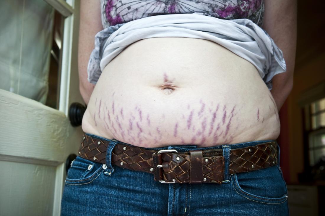 Rid Of Stretch Marks