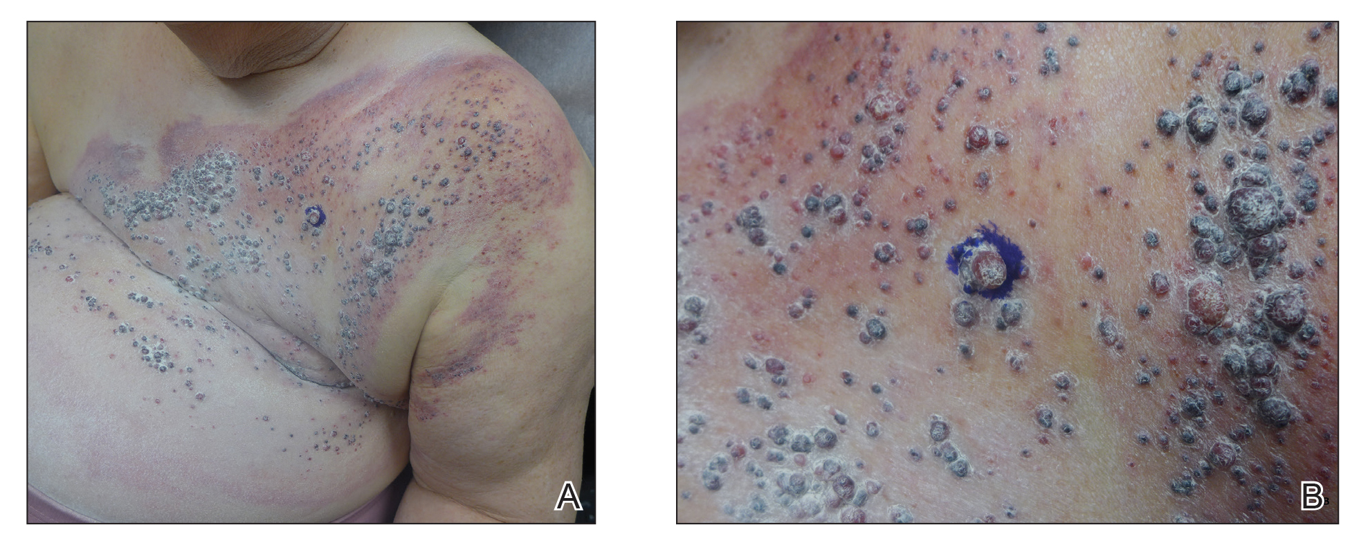 Breast Cancer Metastasis