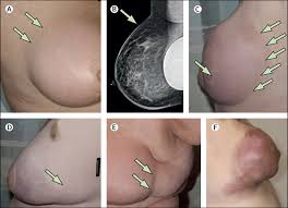Breast Cancer