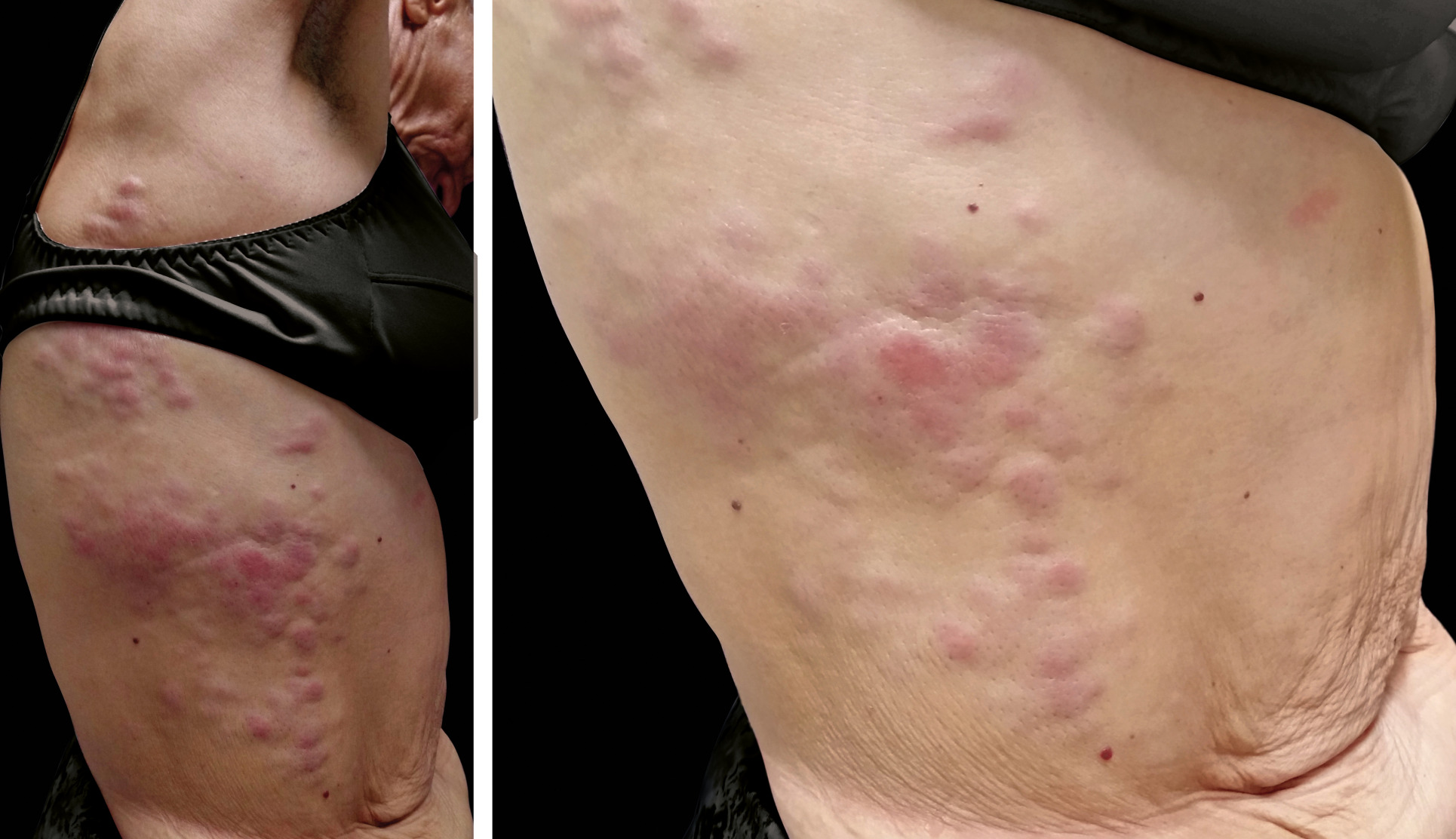 Metastatic Breast Cancer