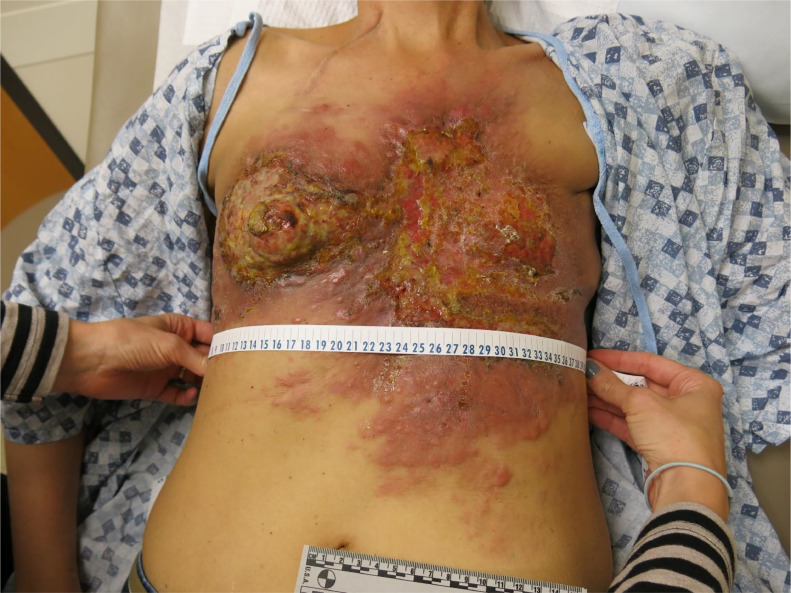 Metastatic Breast Cancer