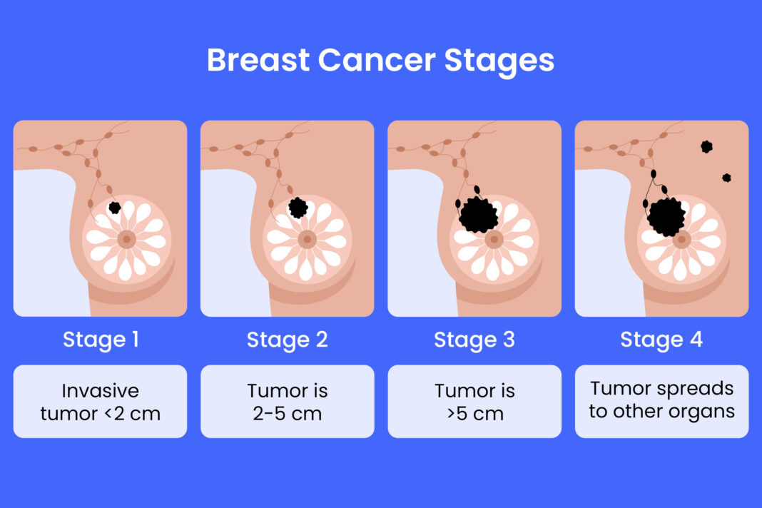 Stages of Breast Cancer