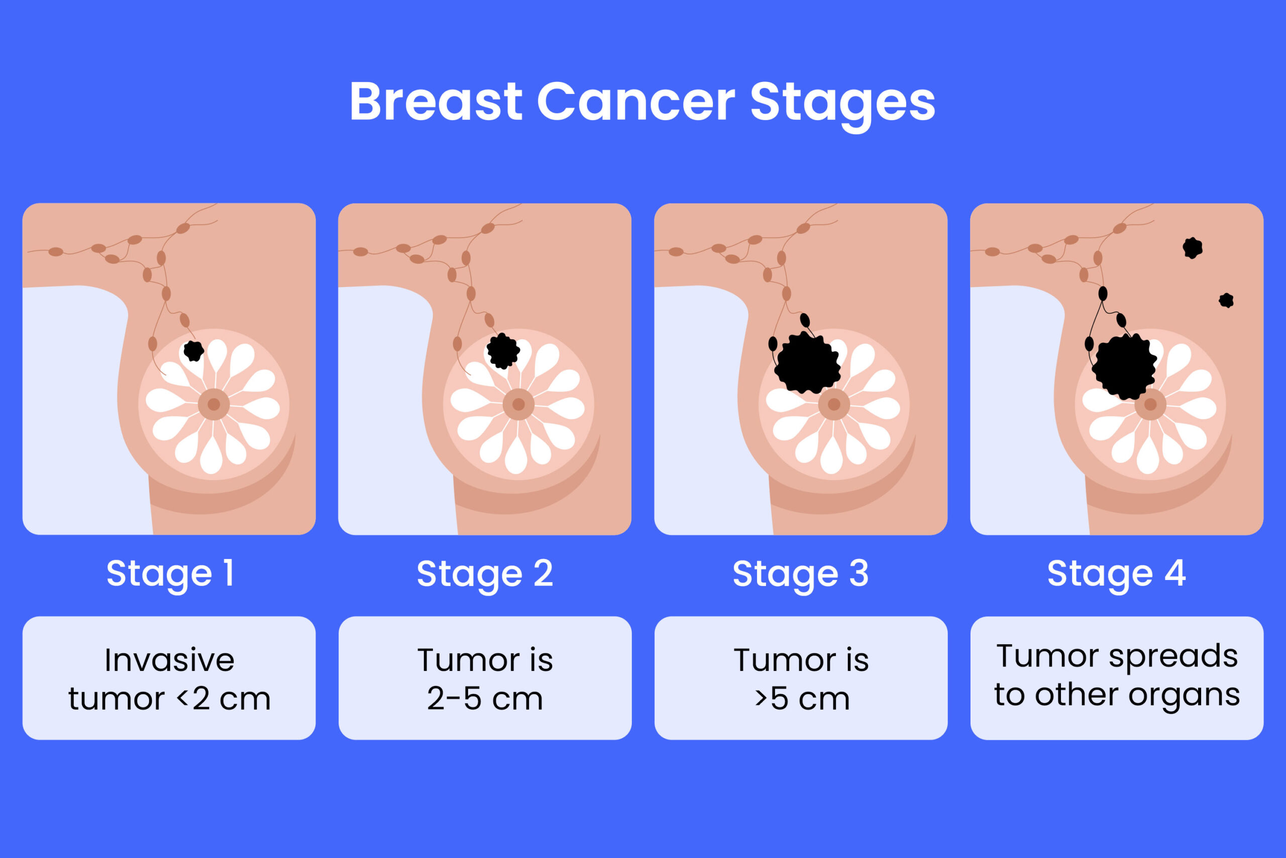 Stages of Breast Cancer
